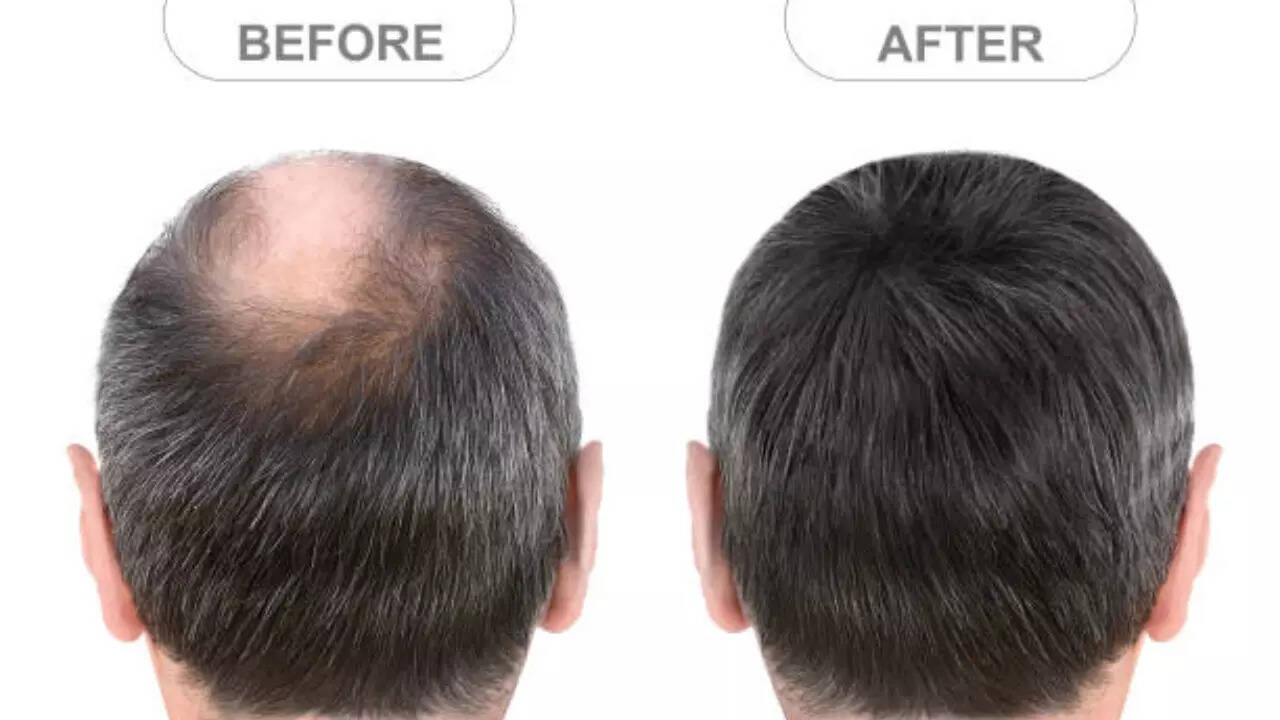 Why This New Oral Minoxidil Could Be the Hair Growth Miracle You've Been Waiting For Why This New Oral Minoxidil Could Be the Hair Growth Miracle You've Been Waiting For