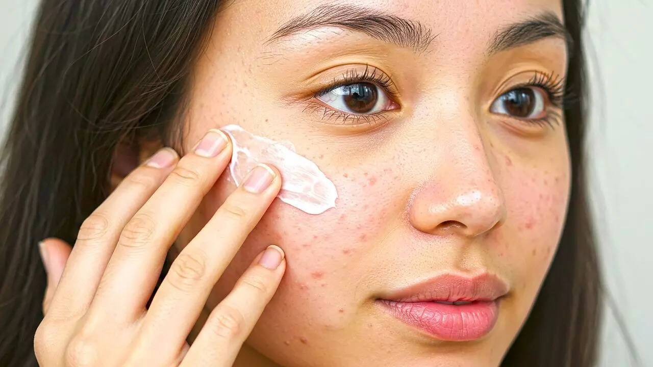 Post-acne care to prevent further scars