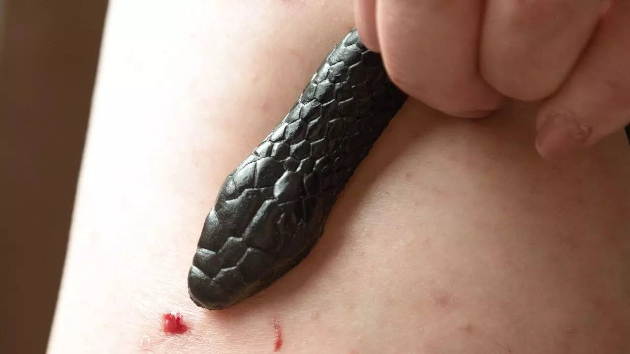 Representative Image-- Snake bite