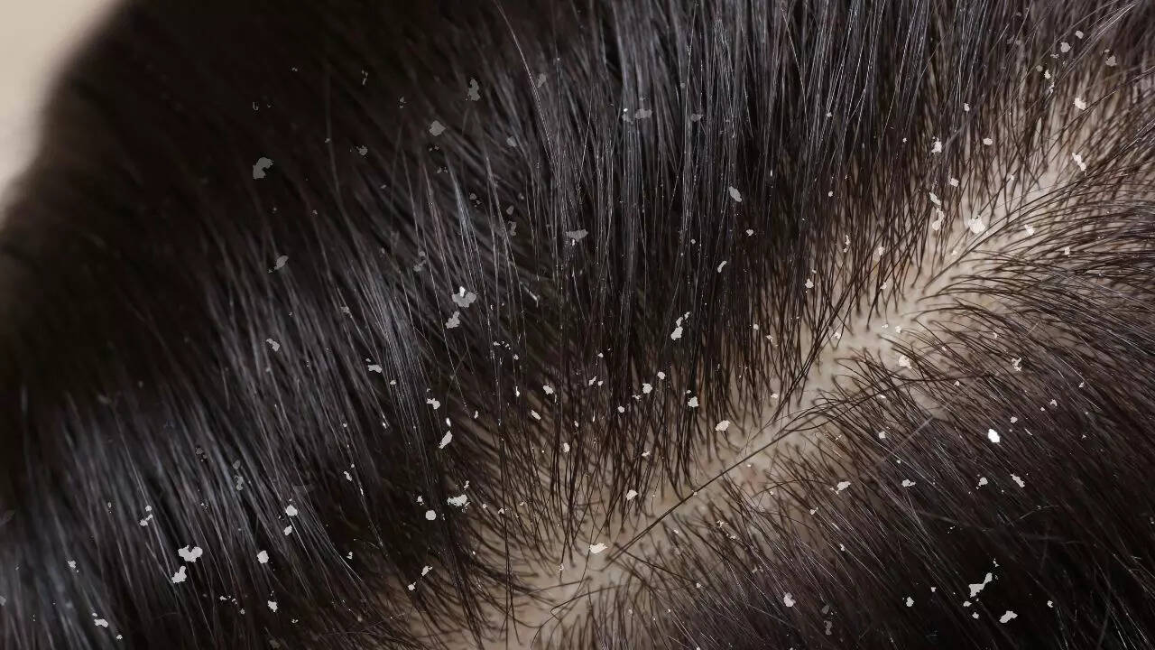 Can eggs remove dandruff naturally? The science behind egg masks for a flake-free scalp | Best ways to use eggs for dandruff removal