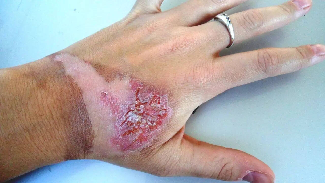 Safe first aid for burns