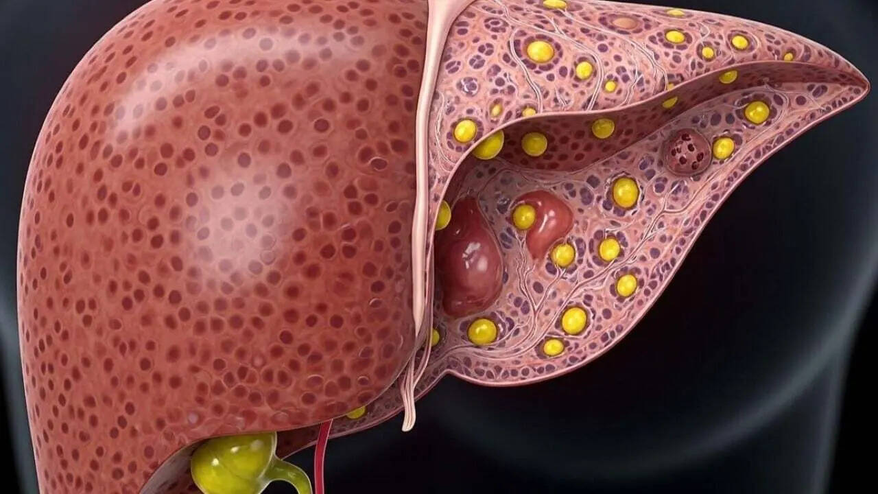 Non-alcoholic fatty liver disease