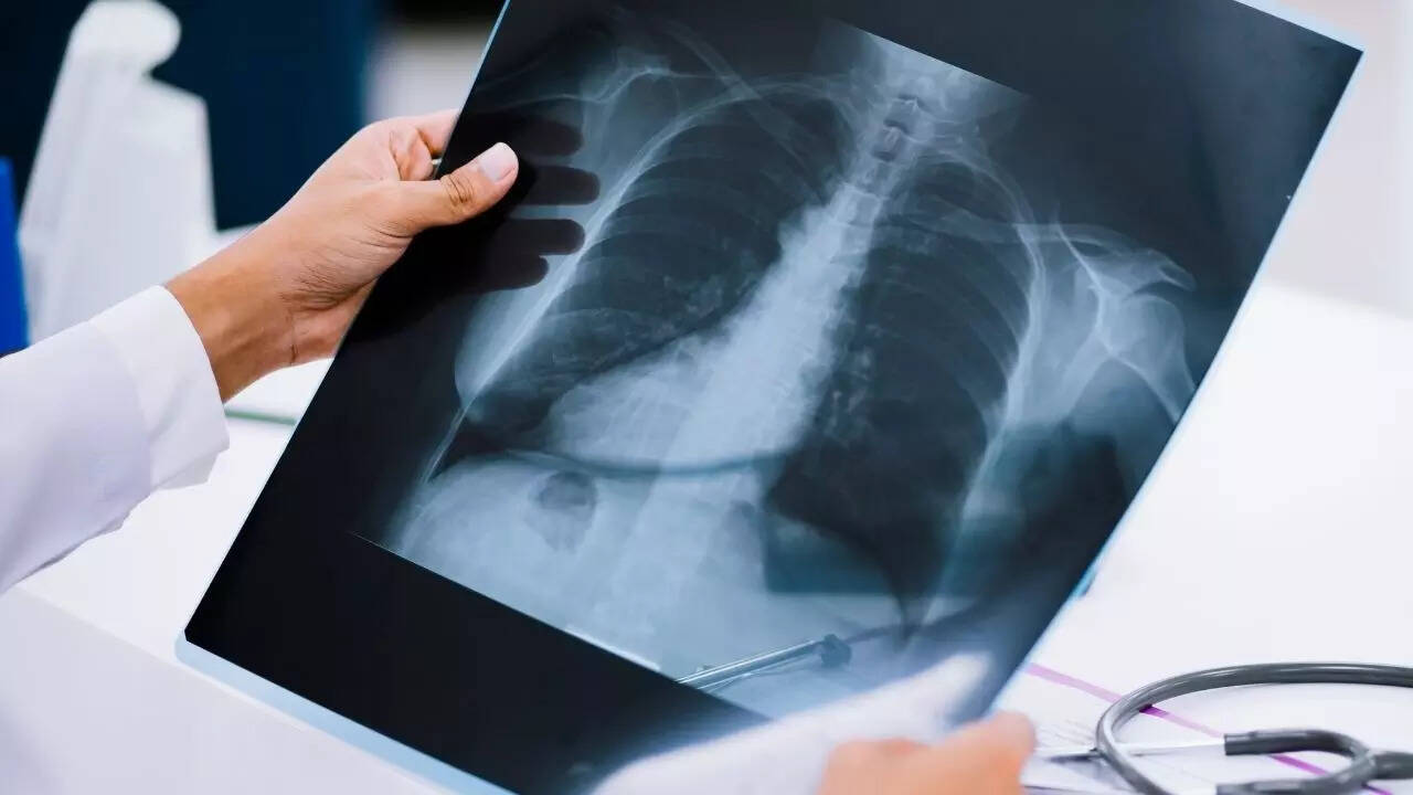 When are chest X-rays actually needed? (Image: Canva)