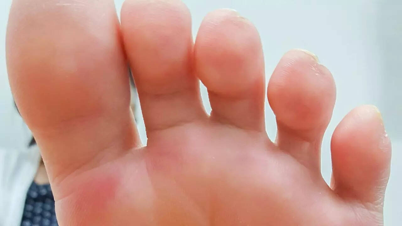 Medical treatments for stubborn sweaty feet