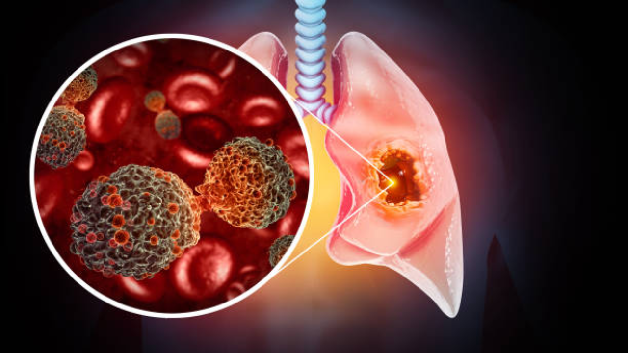 Lung cancer alert: India on the brink of a tsunami of cases, finds study; Oncologist answers 5 critical questions