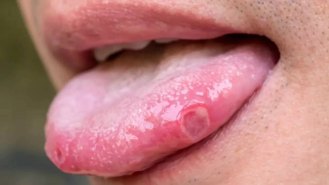 Sore or smooth tongue ulcers