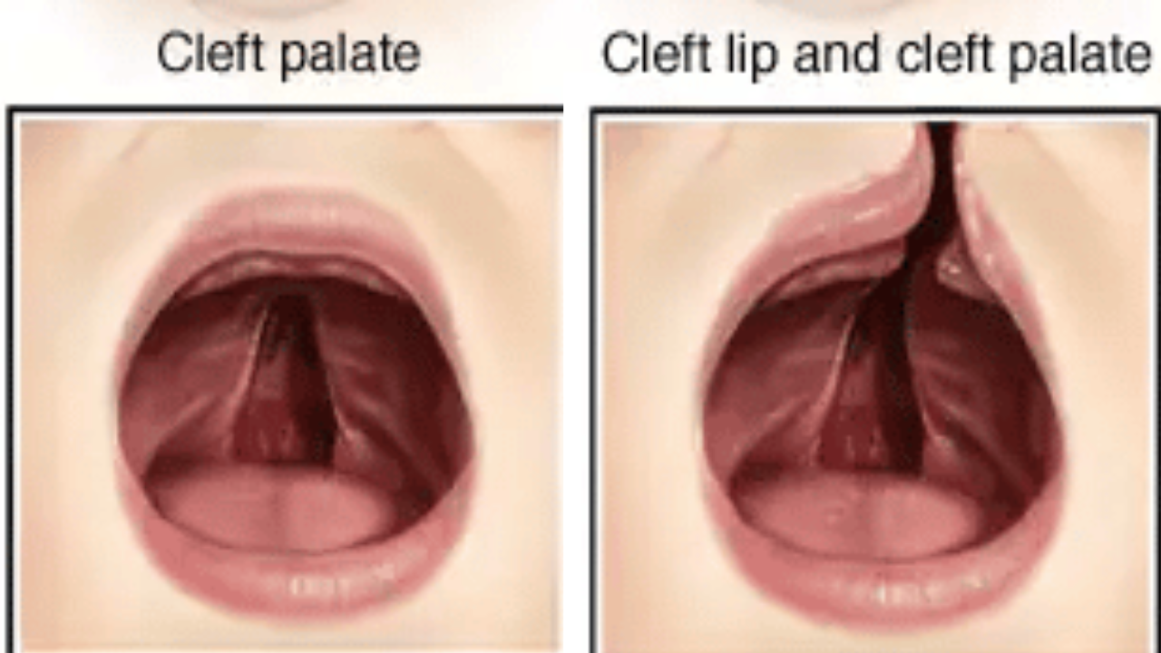 Cleft palate/Representative Image Cleft Palate