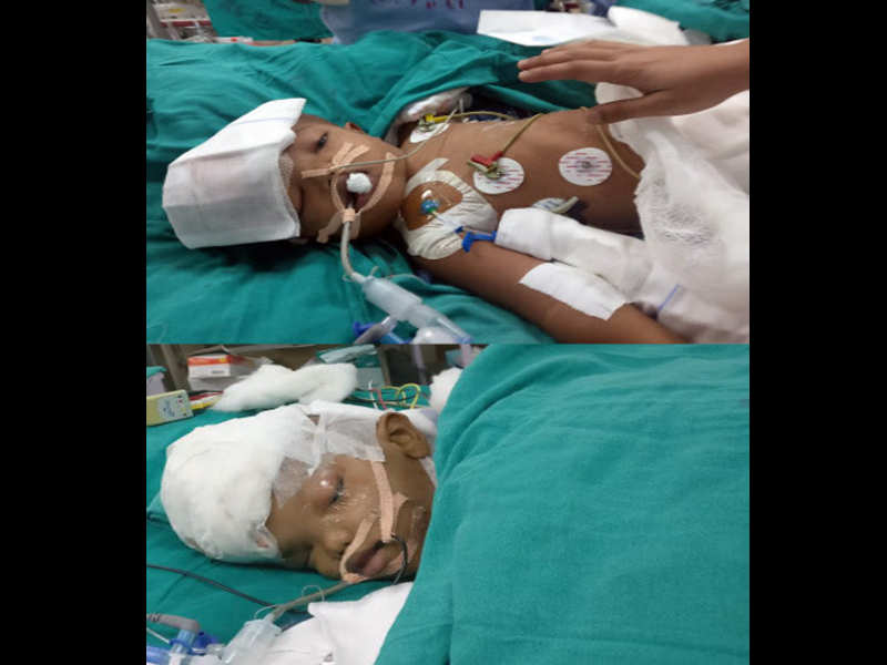 2 Sets Of Conjoined Twins Come To Aiims For Surgical Separation Delhi News Times Of India
