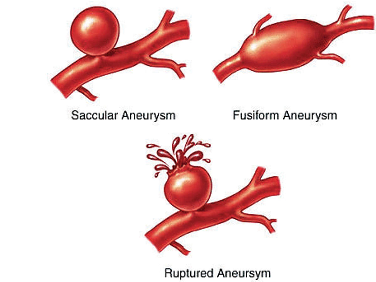 Аневризма. Фузиформная аневризма головного мозга. Саккулярная аневризма. Фузиформная аневризма аорты. Веретенообразная аневризма.