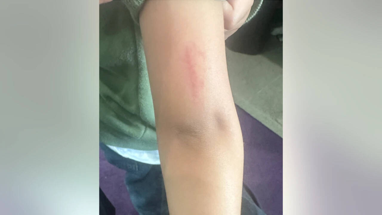 <br>Photo taken after the April 27 incident shows bruising on the child's arm.