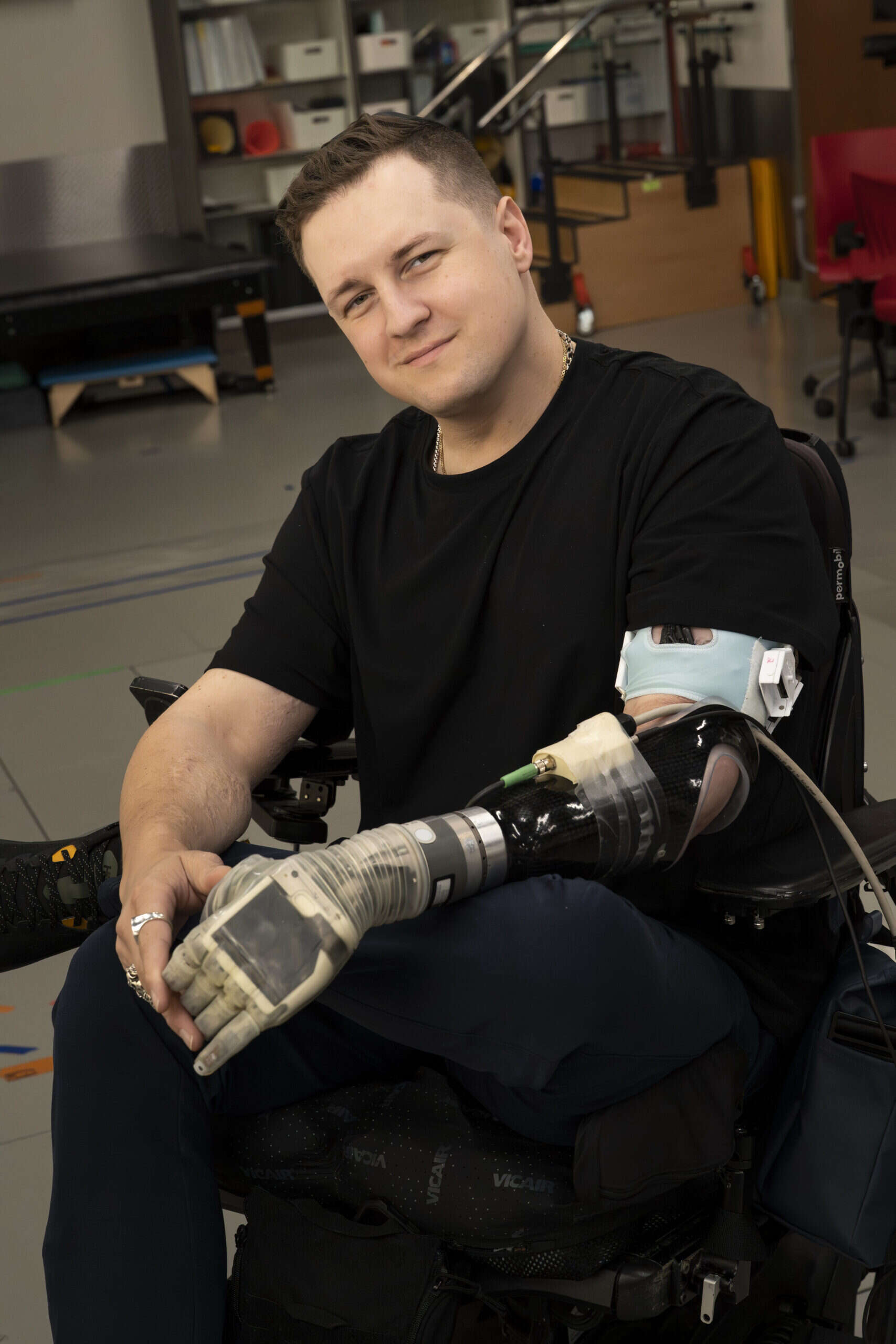 17 years after amputation, man gets bionic arm with touch