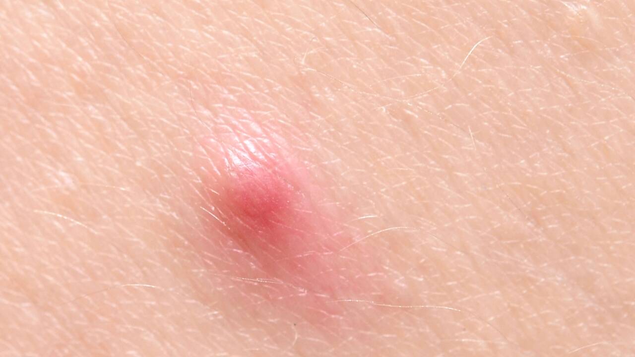 claasic pimple