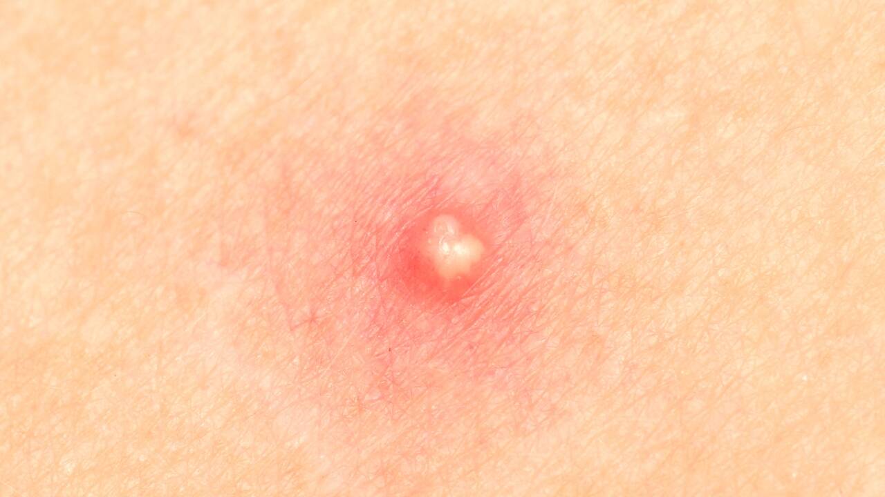 pustules