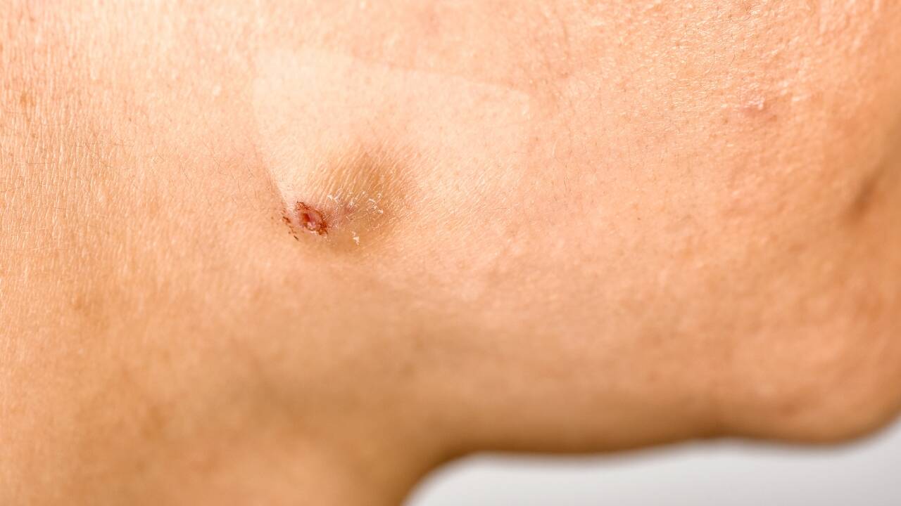 5 different types of acne on the skin, what causes them and simple home remedies to fix them