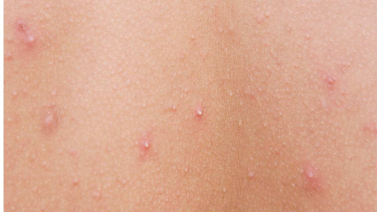 5 different types of acne on the skin, what causes them and simple home remedies to fix them