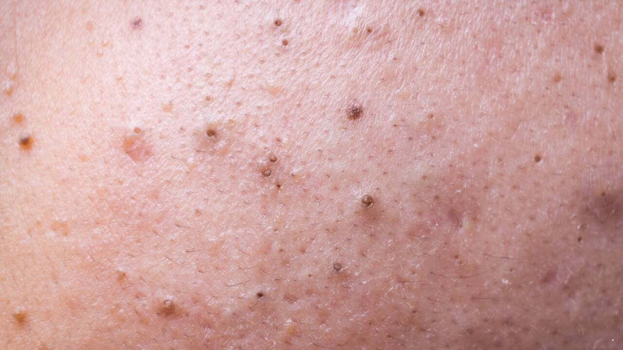 Black heads