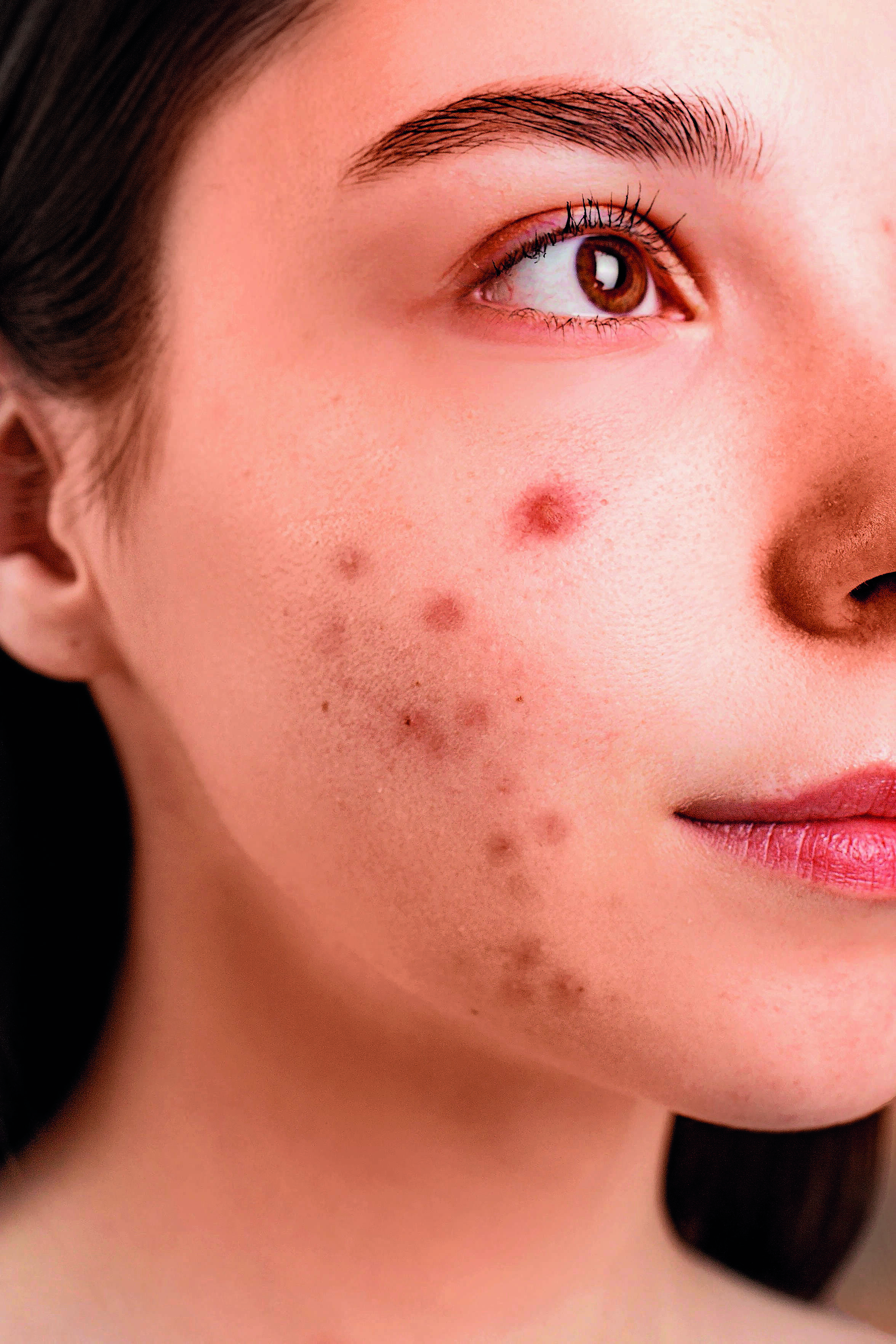 Understanding Multimeter Signs Understanding Adult Acne: Causes, Treatments, and Confidence Recovery