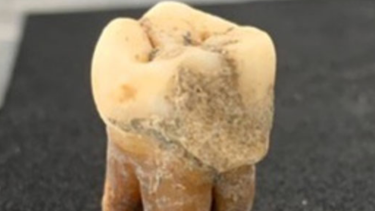 Example of dental calculus attached to an ancient human tooth from the Umeda cemetery in Osaka, Japan<br>Yoko Uchida-Fukuhara<br>