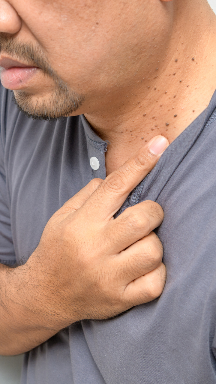 12 warning signs of diabetes on the skin