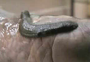 Leech Therapy Getting Popular In Tamil Nadu News Times Of India Videos