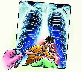 ‘govt’s Efforts To Tackle Tb Evident’ | Lucknow News – Times of India