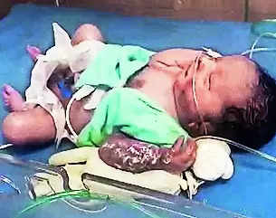 Newborn In Warmer Suffers Burns In Hosp | Jaipur News – Times of India