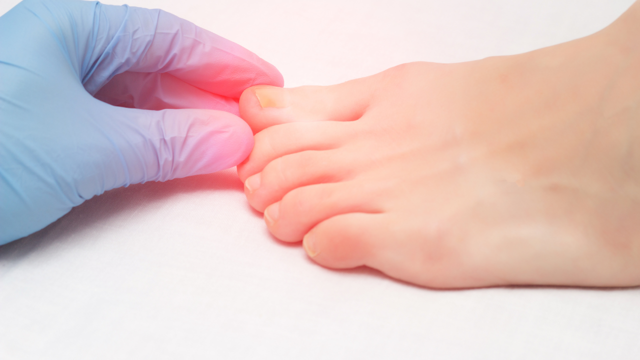 fungal infection