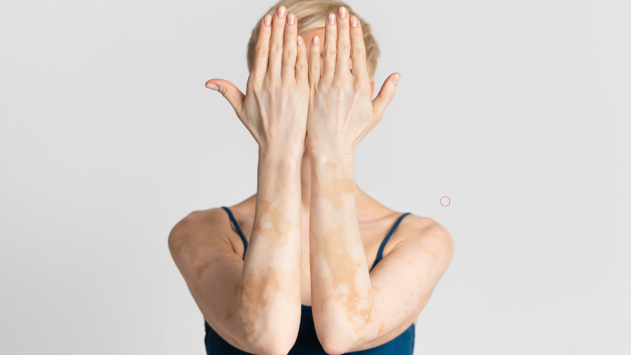 Vitamin B deficiency (2)