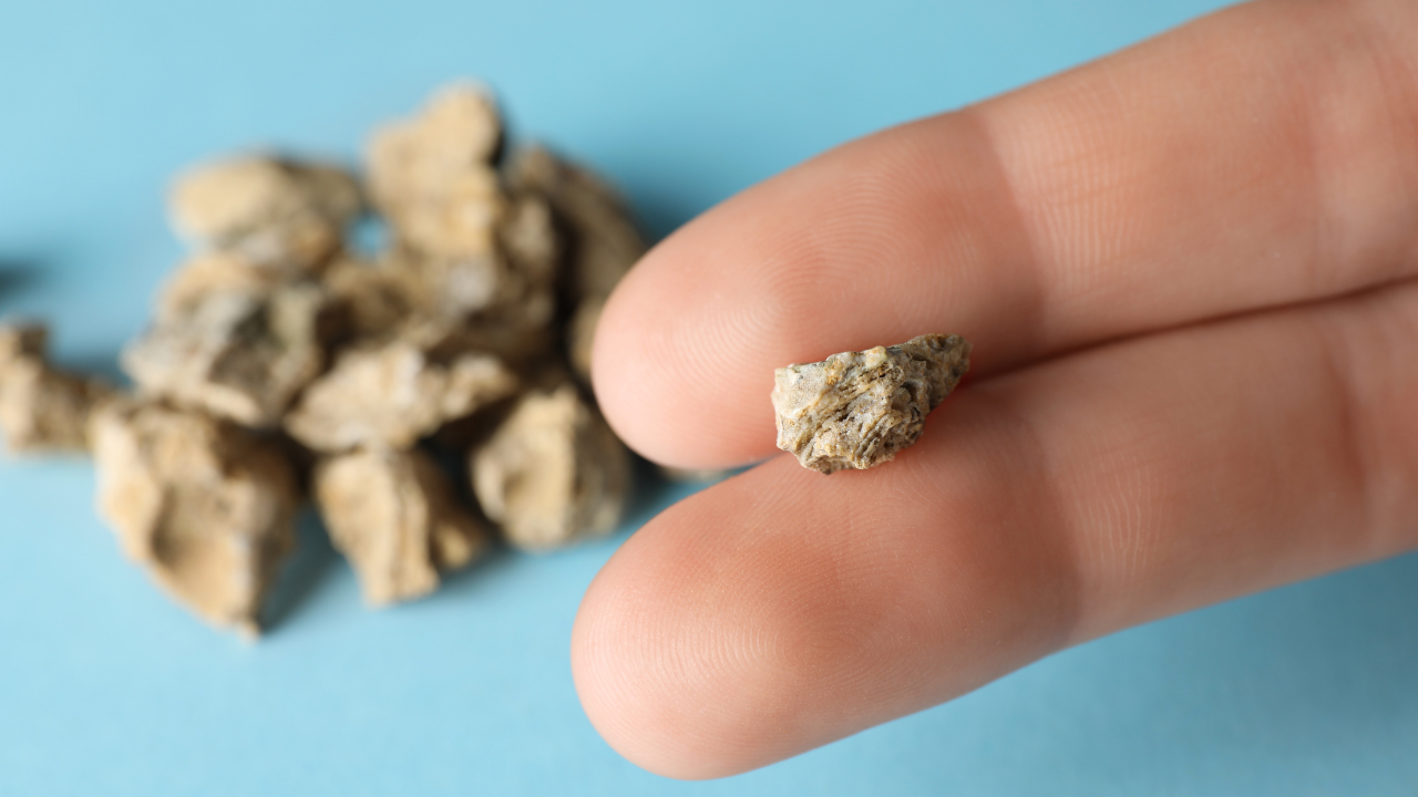 Reason for kidney stone cases rise among young people