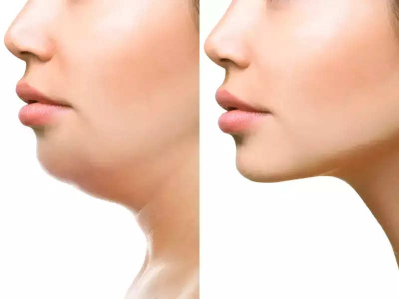 Is jawline correction surgery right choice for you? Expert opinions from Gurgaon doctors