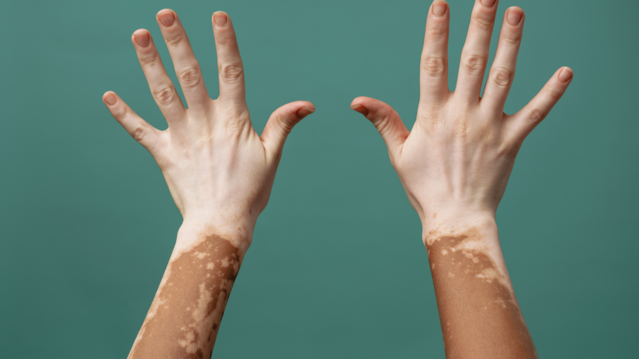 Holistic ways to heal skin disorders like vitiligo and psoriasis