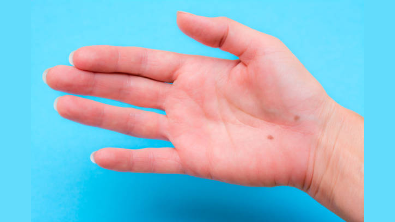 What do moles on different parts of the hand mean?