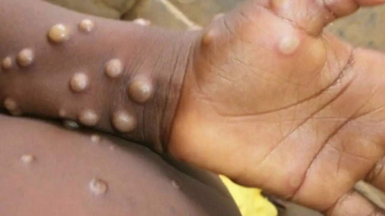 ‘Deadliest’ mpox variant spreads in multiple African countries; know signs and symptoms