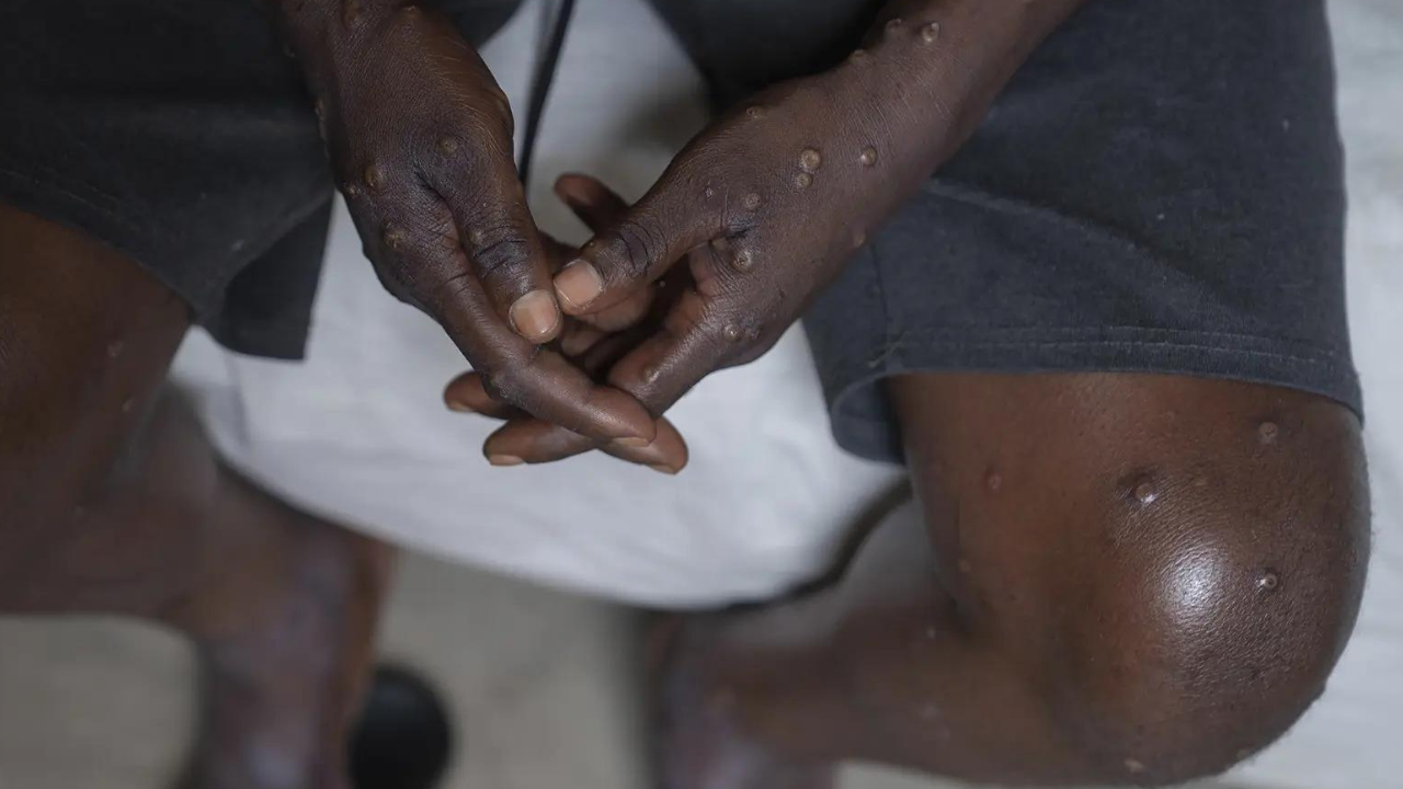 WHO declares mpox a global health emergency: What is mpox, can the virus spread, How can it be stopped