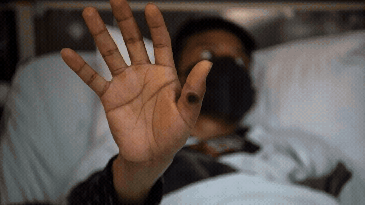 Pakistan detects first mpox case of 2024, China to screen arrivals