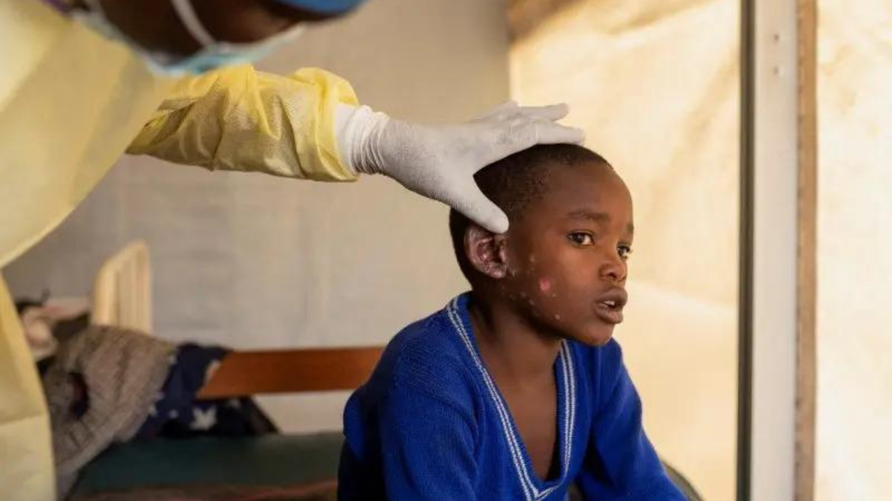 WHO, partners meet to avoid Covid failures on fair medical access for mpox