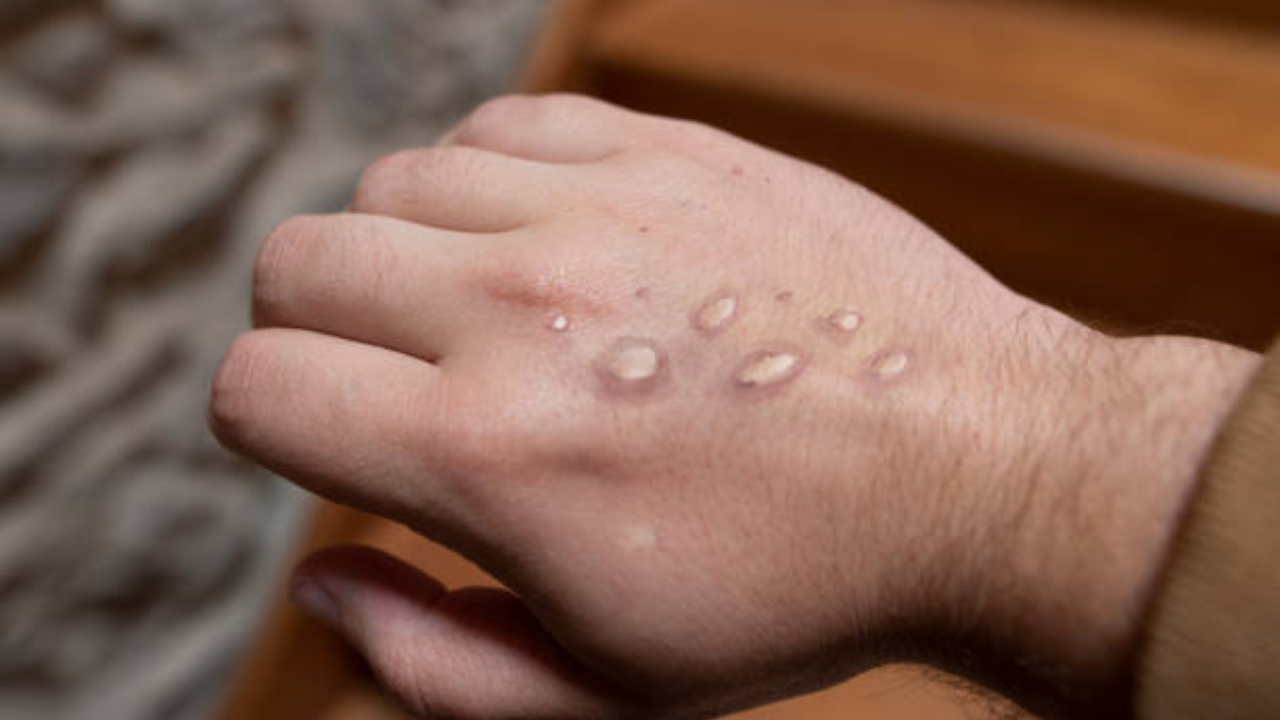 monkeypox (3)