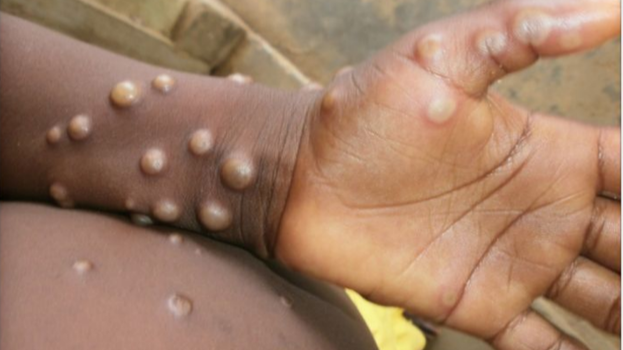 Mpox outbreak: Centre sounds alert at all airports, border land ports