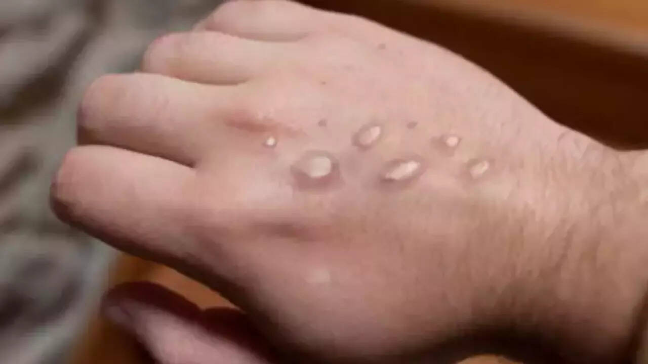 AIIMS issues guidelines for Mpox cases in Delhi