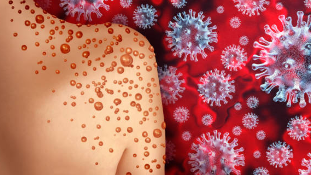 ​Monkeypox vs chickenpox: Which one is more severe?​