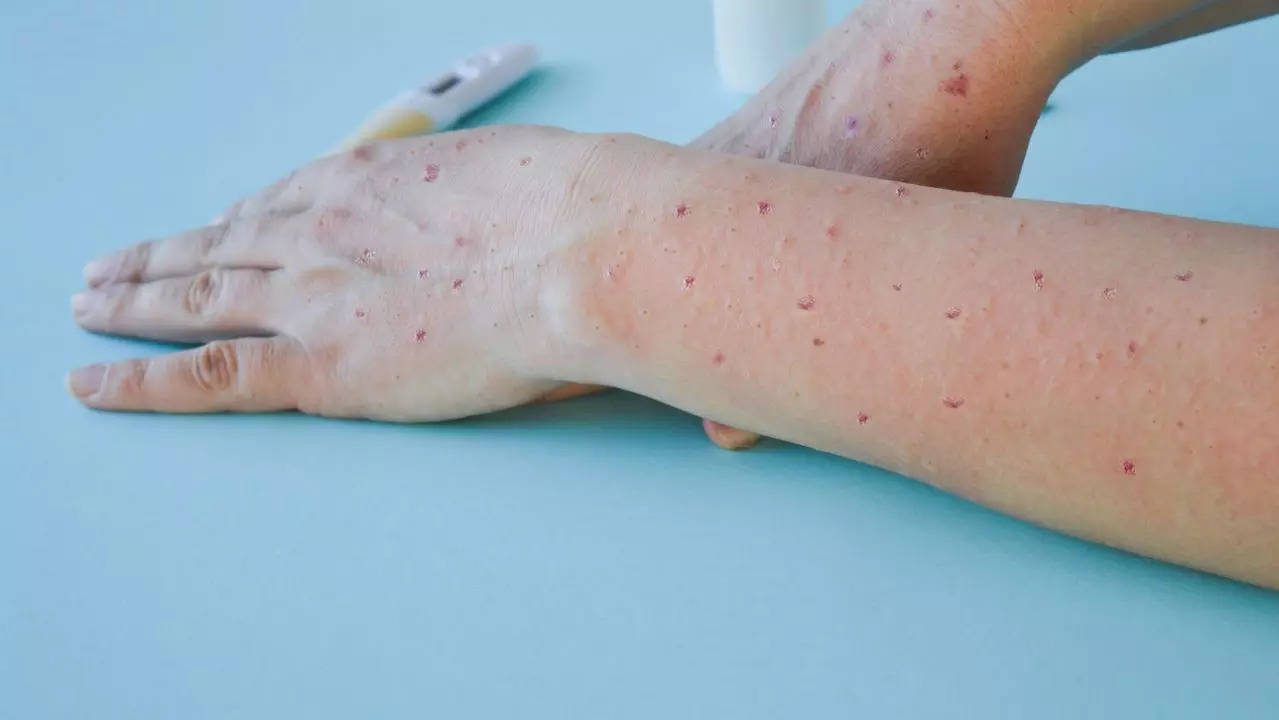 Mpox in kids: 10 early signs and symptoms found in children