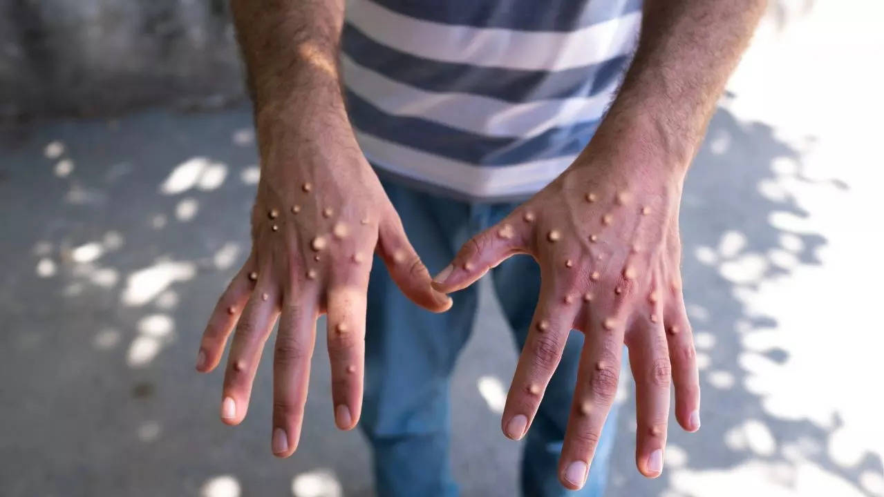 Mpox danger signs: 6 severe symptoms to watch out for amid outbreak