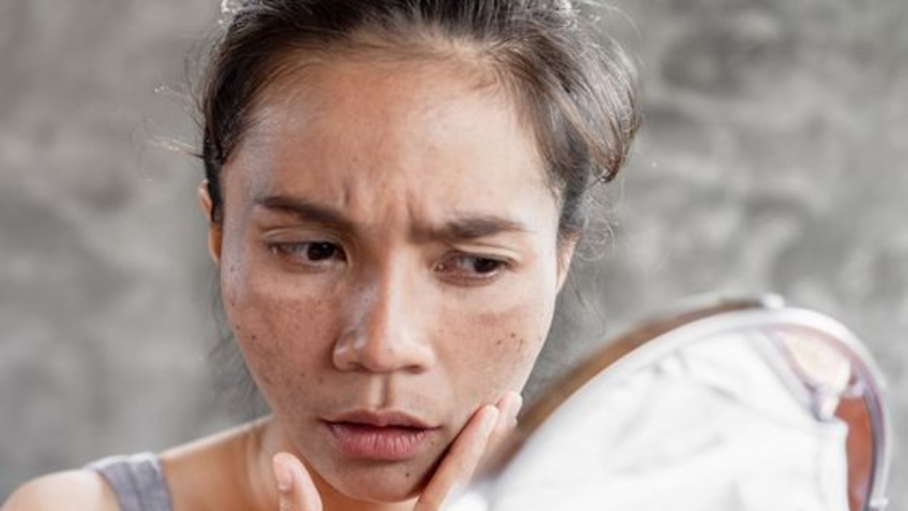 Tranexamic Acid removes dark spots