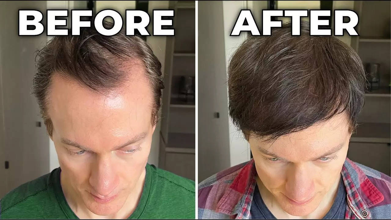 Millionaire Bryan Johnson reveals how he hacked genetic baldness and premature hair greying