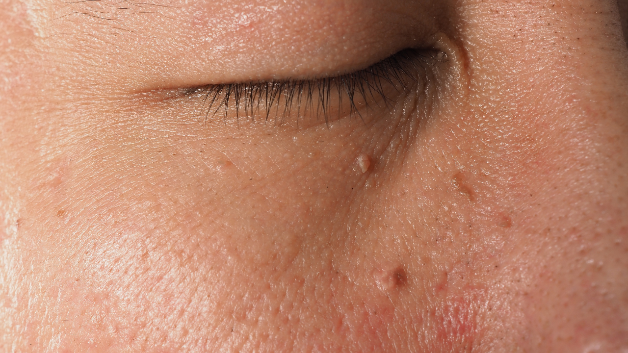 Skin tags: Can they be cancerous and how to prevent them?