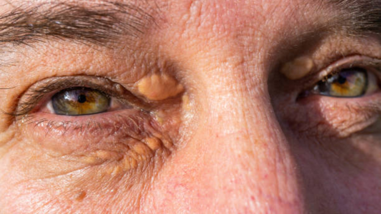 Are the harmless eyelid bumps a hidden danger?