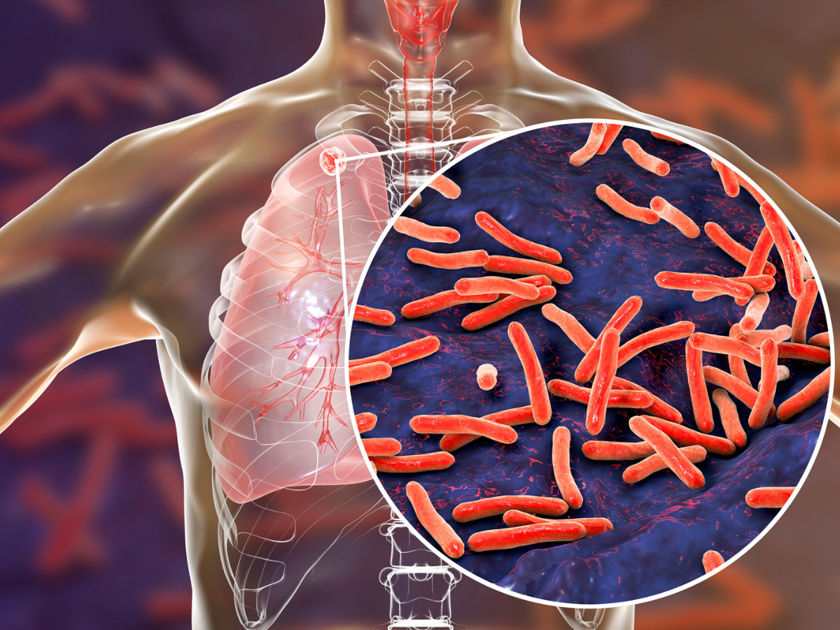 Tuberculosis