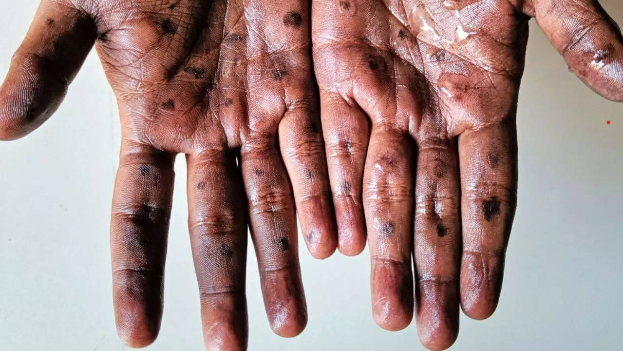 First case of severe Mpox strain in US: Signs and symptoms to know