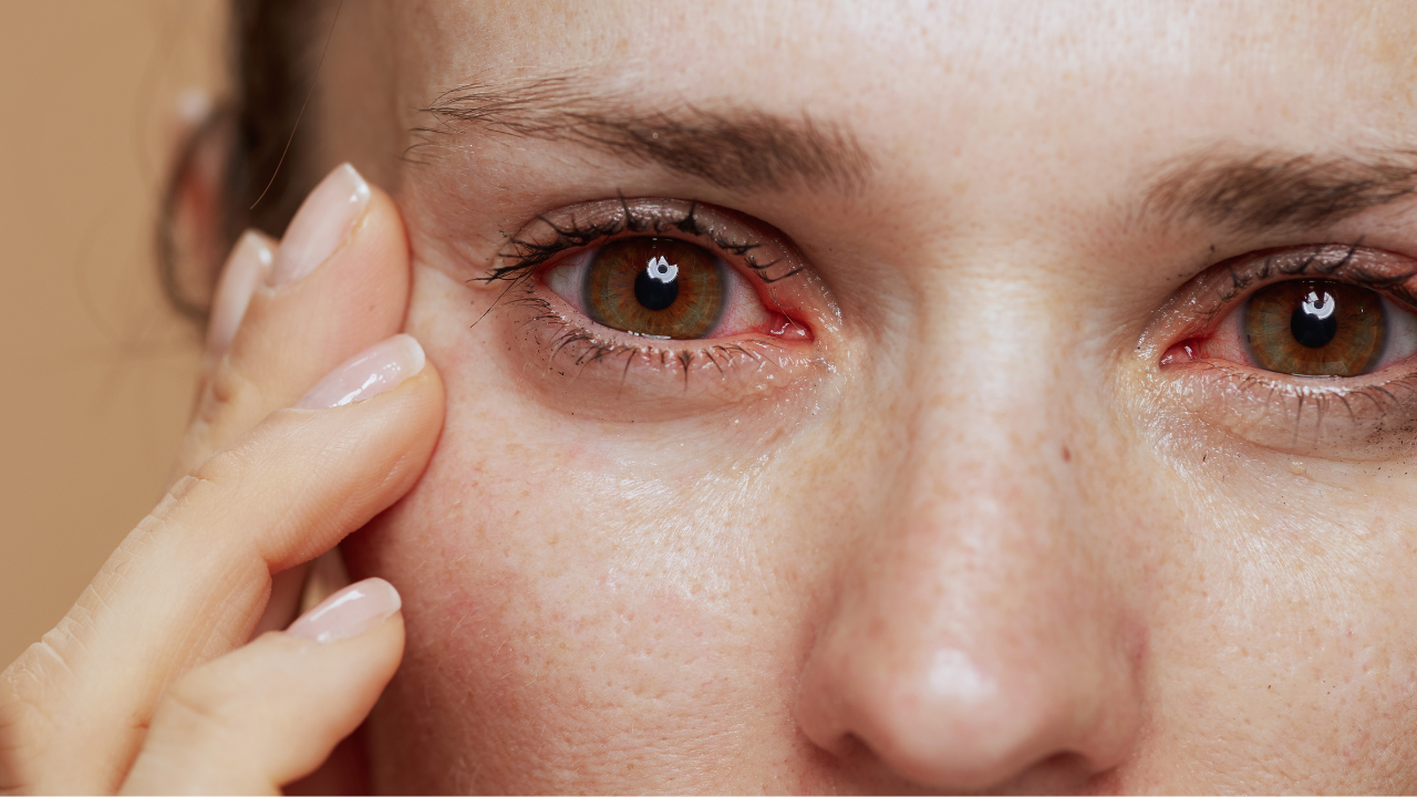 Bleeding eyes virus sparks global alert: Travelers urged to take precautions amid outbreaks