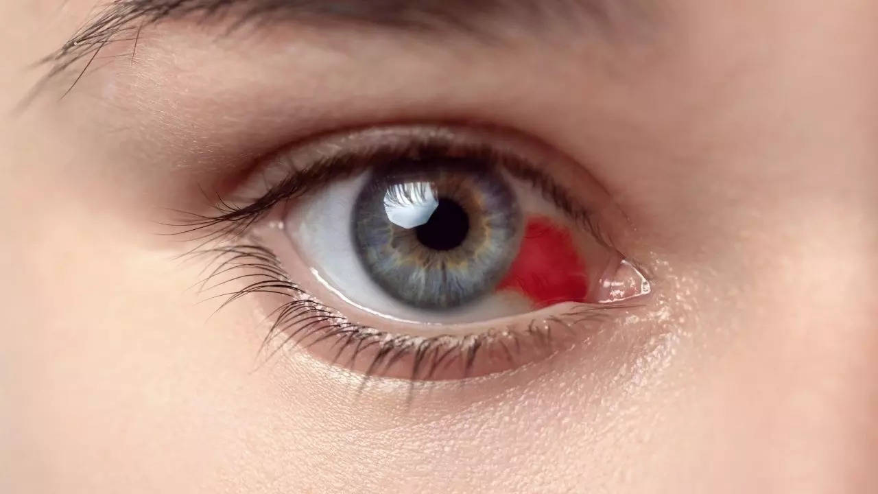 Bleeding eye disease with 50 pc survival rate a cause of concern